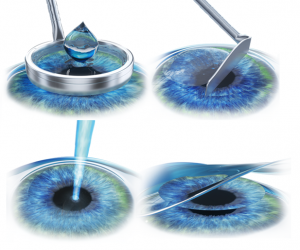 miopie operație ochi